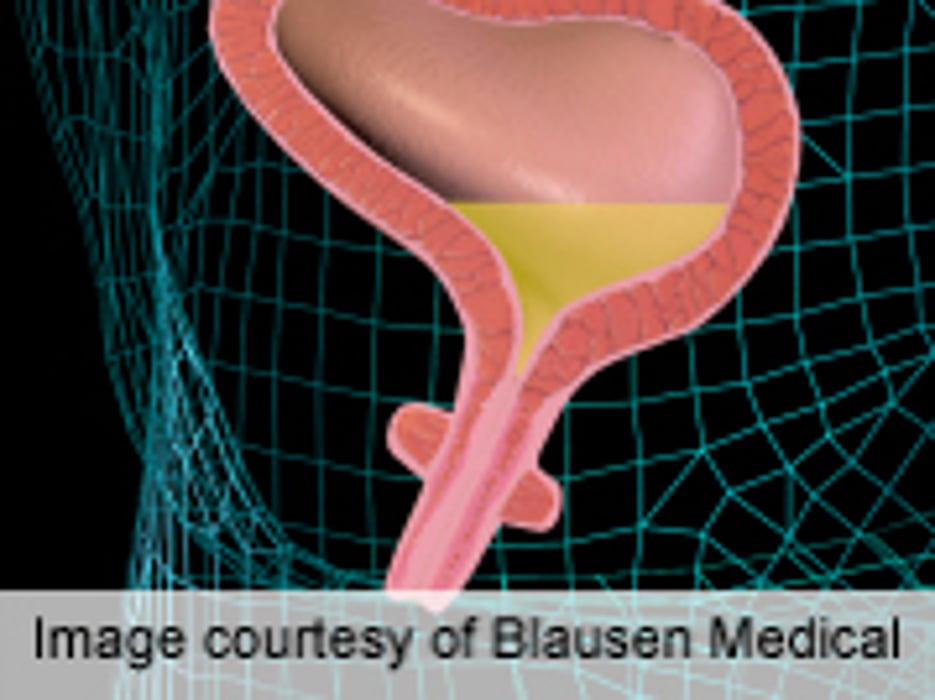 Intravesical Chondroitin Sulfate of Little Benefit in Cystitis