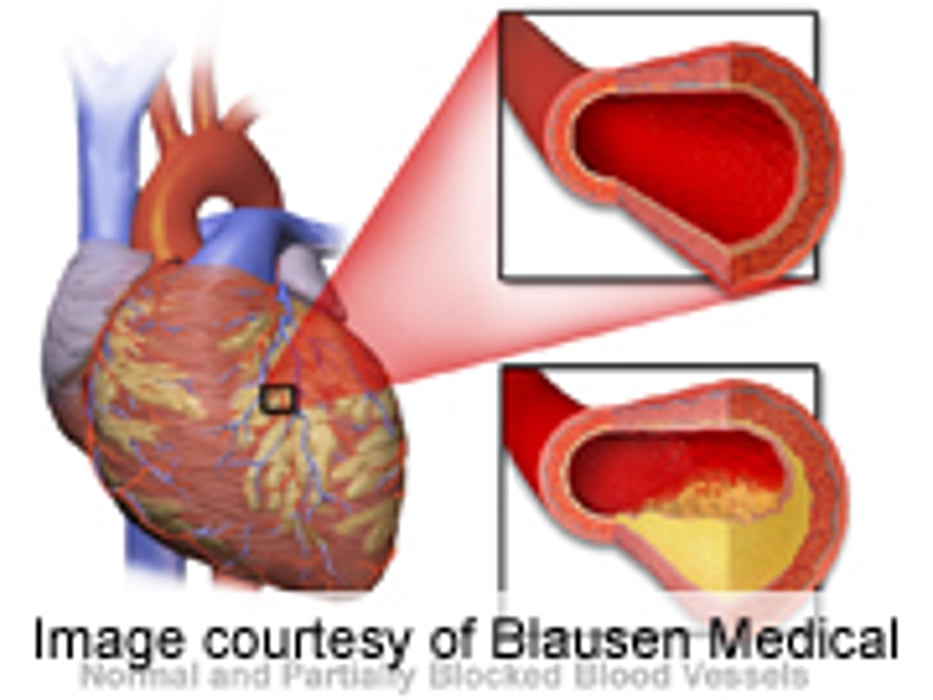 PCI Has Excellent Outcomes for Younger Adults With CAD