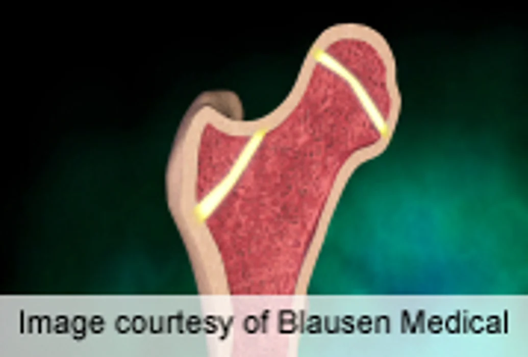 More Research Points to Long-Term Ills With Bone Drugs