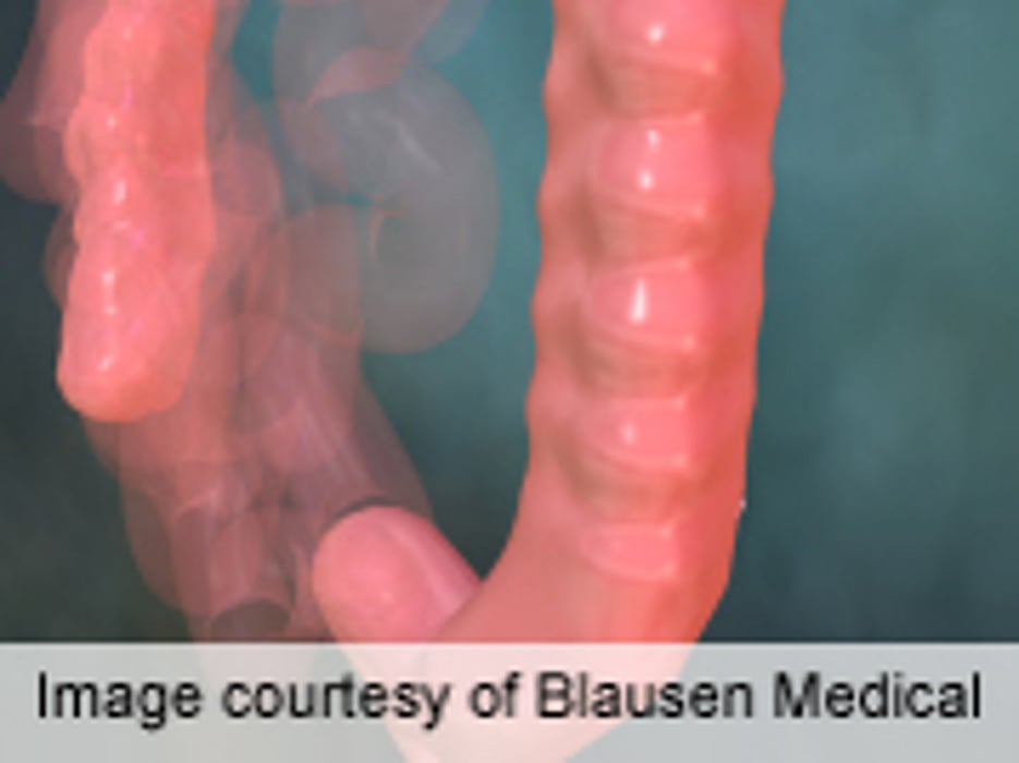 ASCO: Fish, Exercise May Help Thwart Colon Cancer's Return