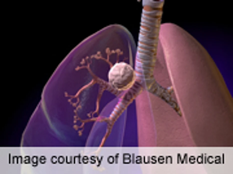 Freezing Treatment May Help Destroy Lung Tumors: Study