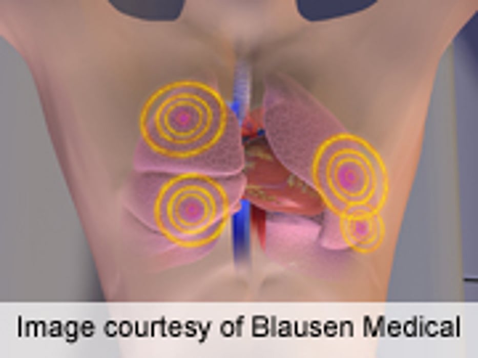 Dual-Source Cardiac CT IDs CAD in Hard-to-Image Patients