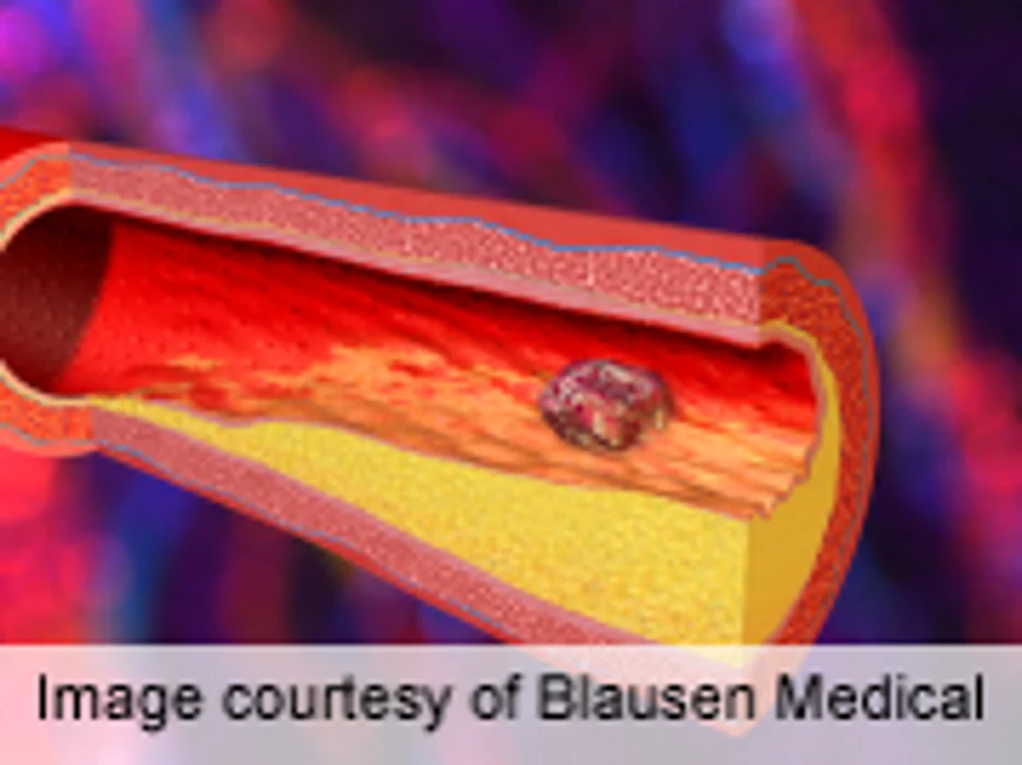 Lower MI Risk With TNF Inhibitor Therapy for Psoriasis