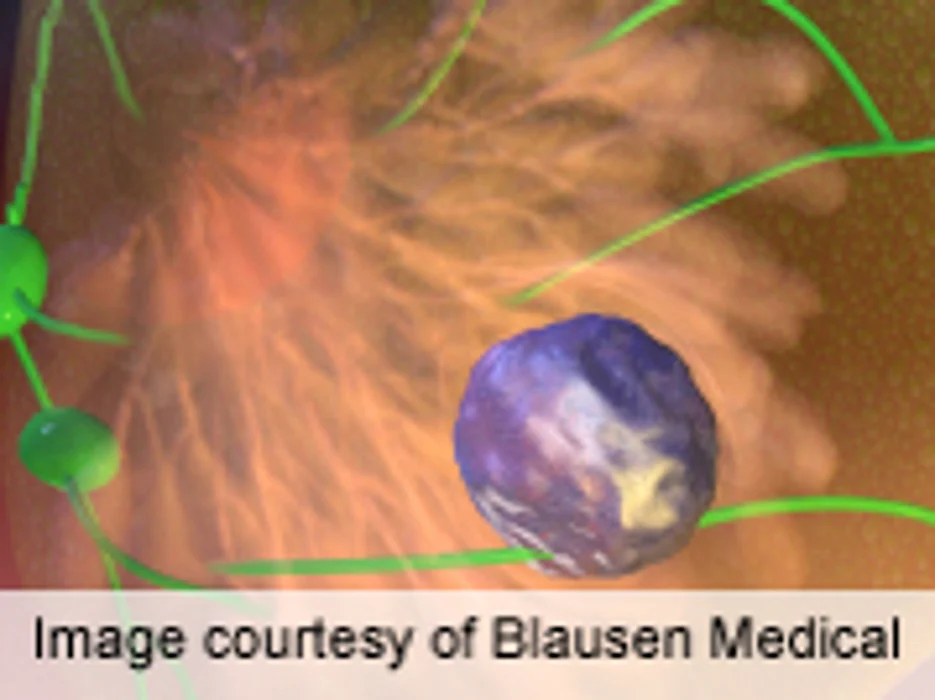 PR+ Cells Add Prognostic Value in Luminal A Breast Cancer