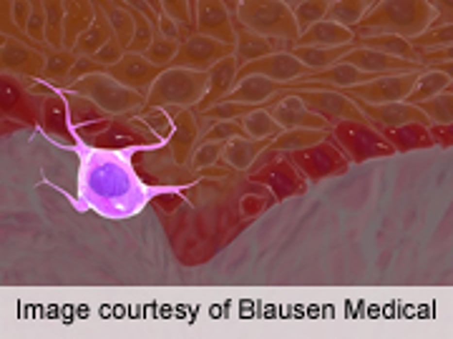 ESMO: Combo Treatments Up Survival in Metastatic Melanoma