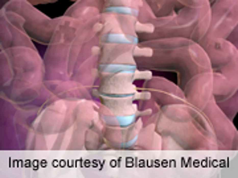 Diabetes Affects Improvements After Lumbar Spine Surgery