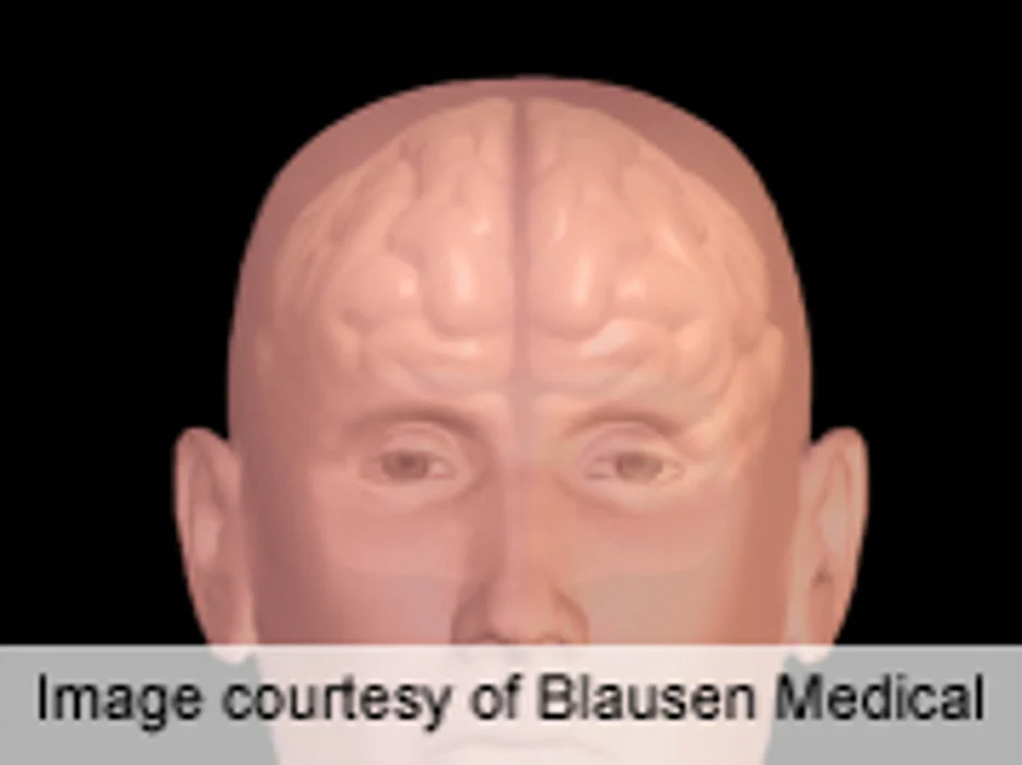 Brain Lesions More Common in High-Altitude Pilots Study Finds