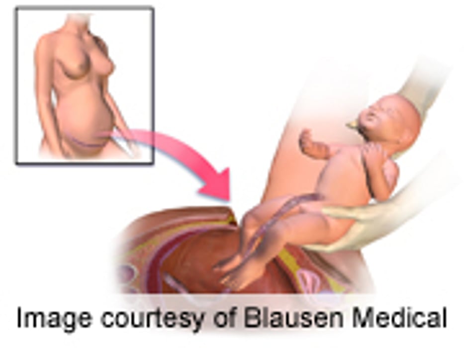 Thromboembolism Prophylaxis Underused After C-Section