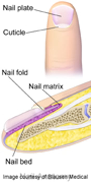 New Peri-Op Approach Accurately IDs Melanoma in Nail Matrix