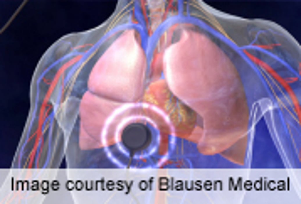 Fatal Airway Necrosis Noted After Stereotactic Body Radiation