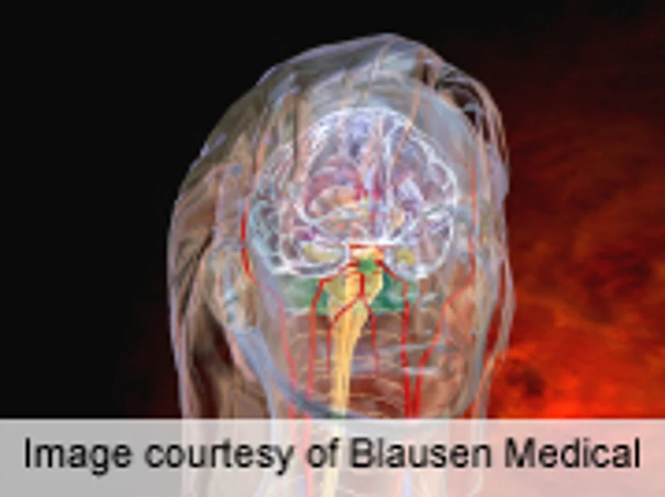 Migraines in Women Tied to White Matter Hyperintensity