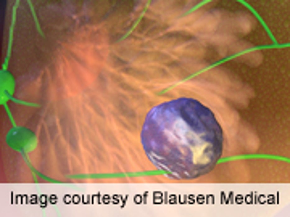 BCS: MarginProbe Reduces Re-Excision Rate Post-Lumpectomy