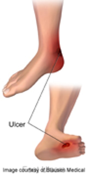 Factors ID'd in Healing Failure of Diabetic Foot Ulcers