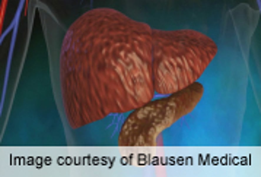 Type 2 diabetes pancreatic cancer