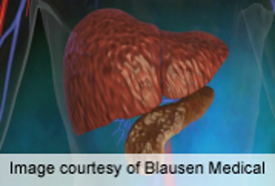 Type 2 diabetes pancreatic cancer