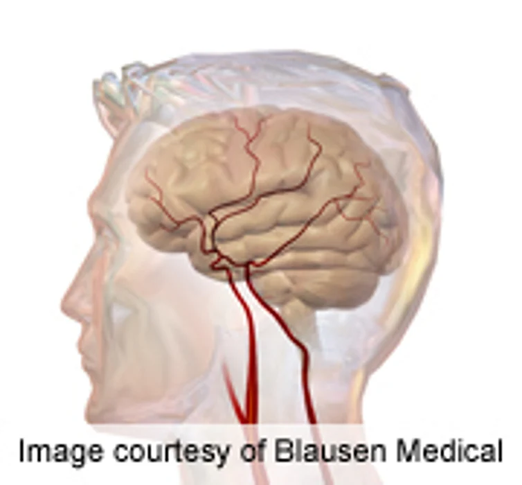 Psychological Distress Increases Cerebrovascular Death Risk