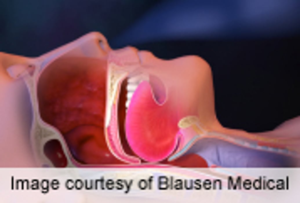 Implantable Device Improves Moderate-to-Severe Sleep Apnea