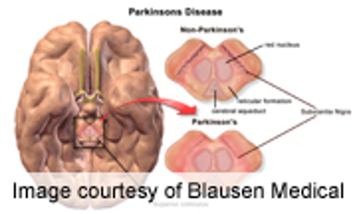 Deep Brain Stimulation Aids Motor Function in Parkinson's