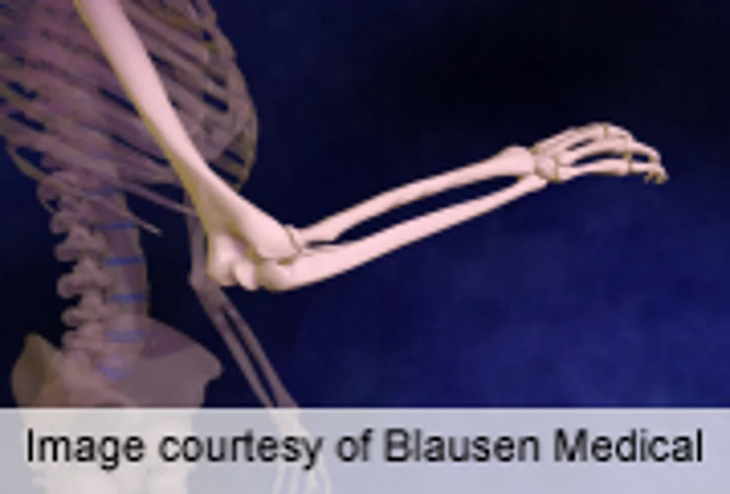 Obesity Complicates Elbow Fractures in Children