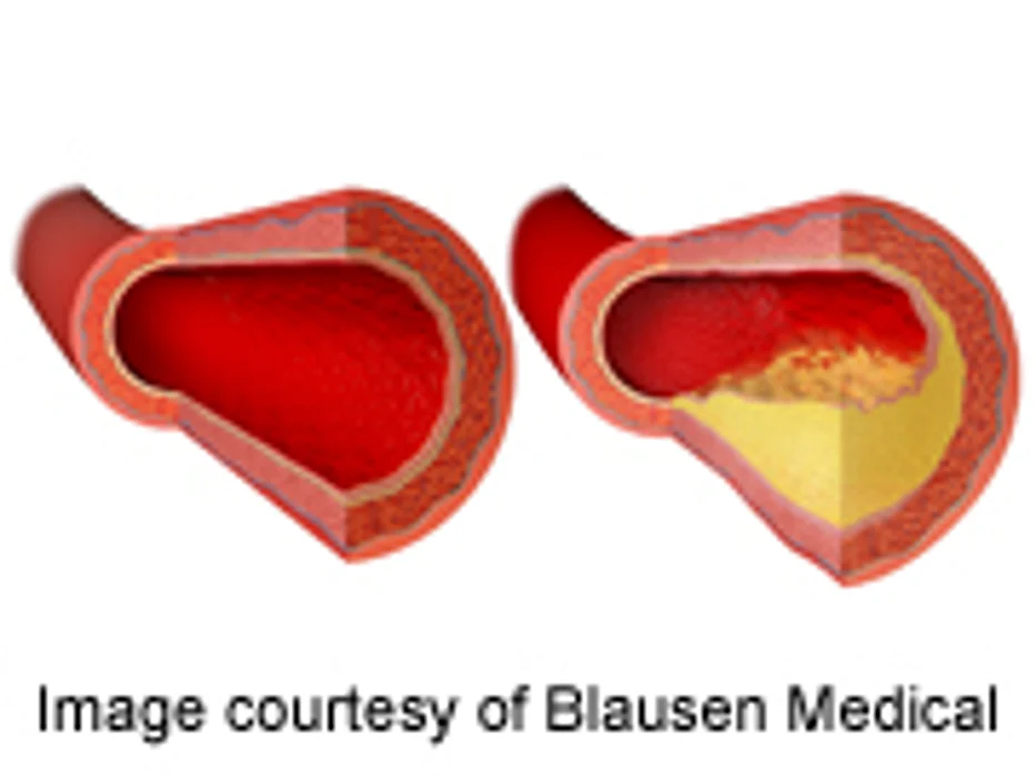 Most Treatments for Blood Clots Appear Safe, Effective