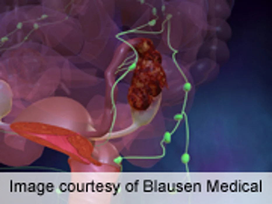 Germ-Line BRCA1/2 Testing Recommended in Ovarian Cancer