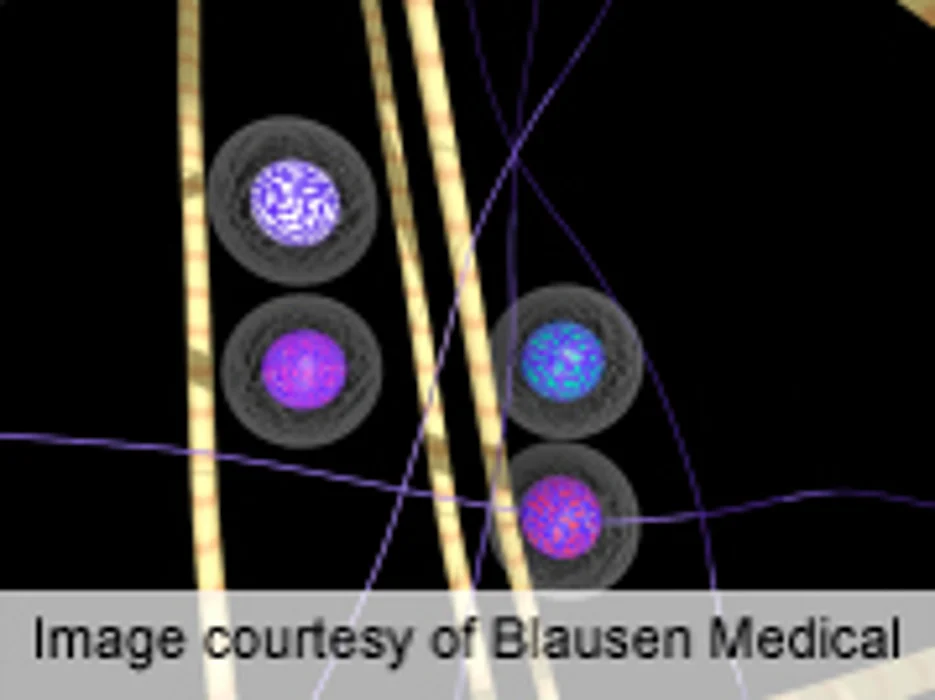 Tumor-Infiltrating Lymphocyte Grade IDs Melanoma Survival
