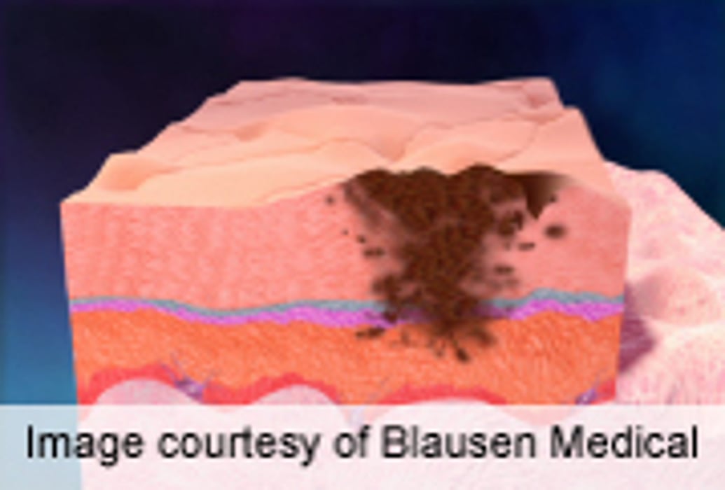 Dermatologist Care Tied to Better Self-Detection of Melanoma