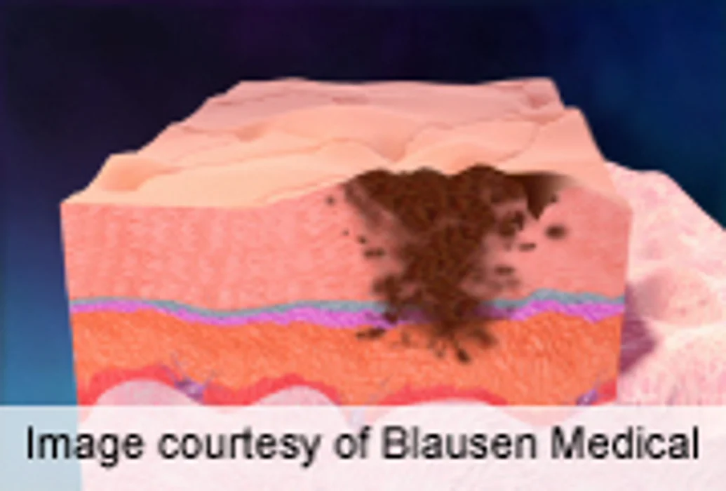 Meta-Analysis Confirms Sunbed, Non-Melanoma Skin Cancer Link