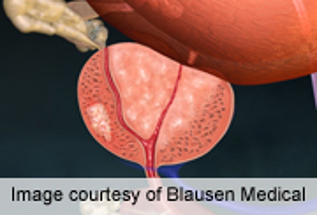 PSA in Midlife Can Predict Later Risk of Prostate Cancer Mets