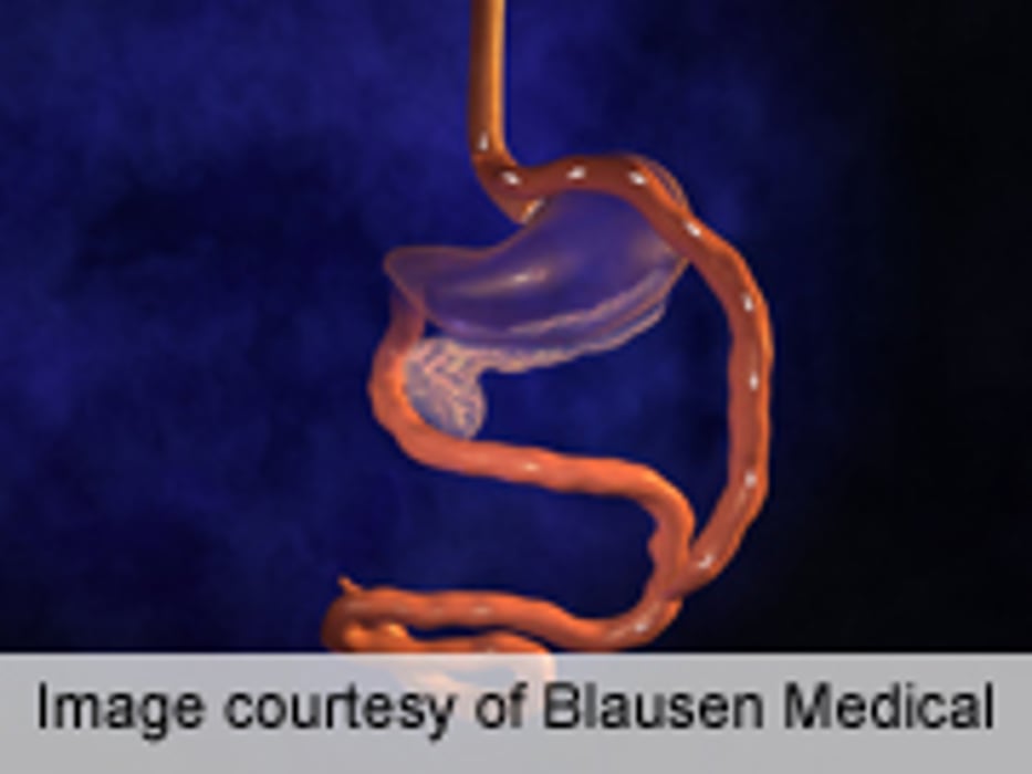 Laparoscopic Safer Than Open Surgery for Gastric Bypass