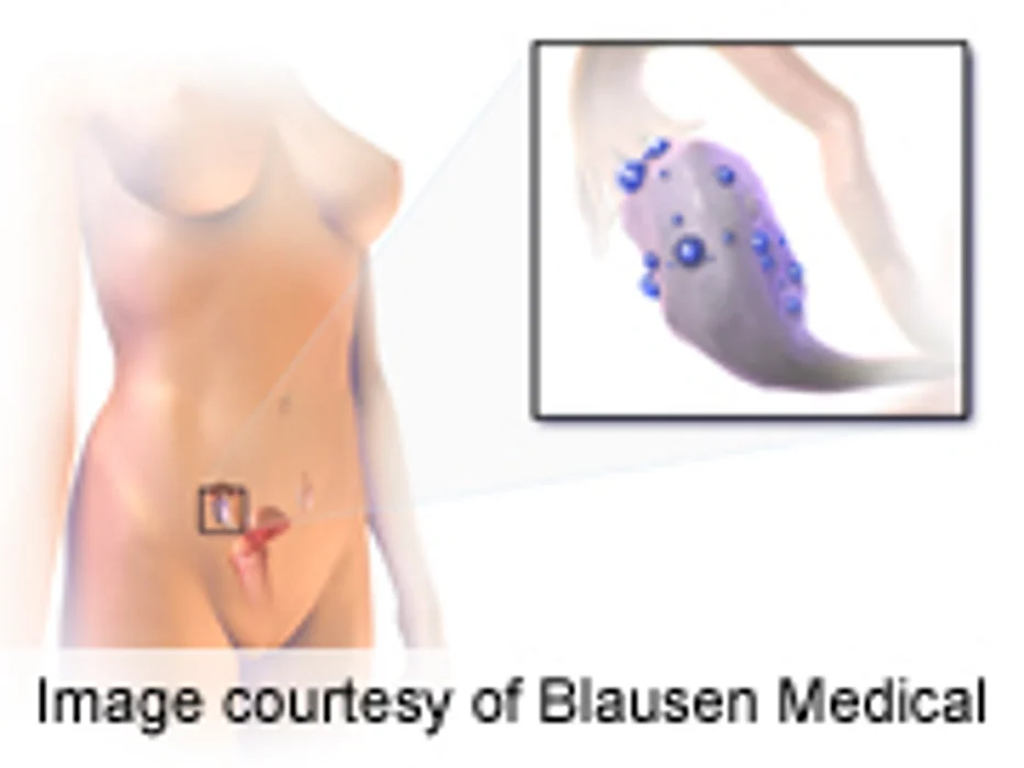 Polycystic Ovarian Syndrome Ups Risk of Type 2 Diabetes