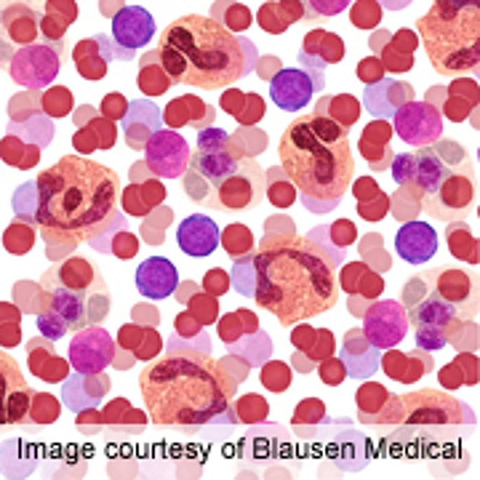 Gene Subnetworks Predict Risk of Leukemia Progression