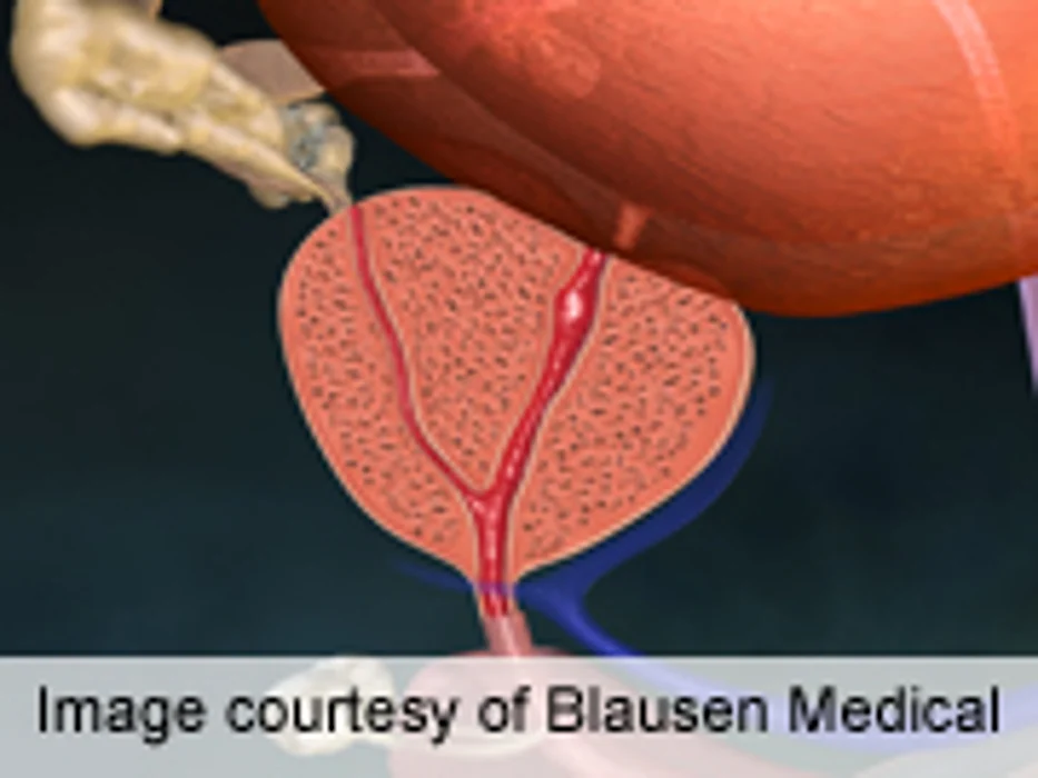 MRI-Targeted Prostate Biopsy May Yield Better Results