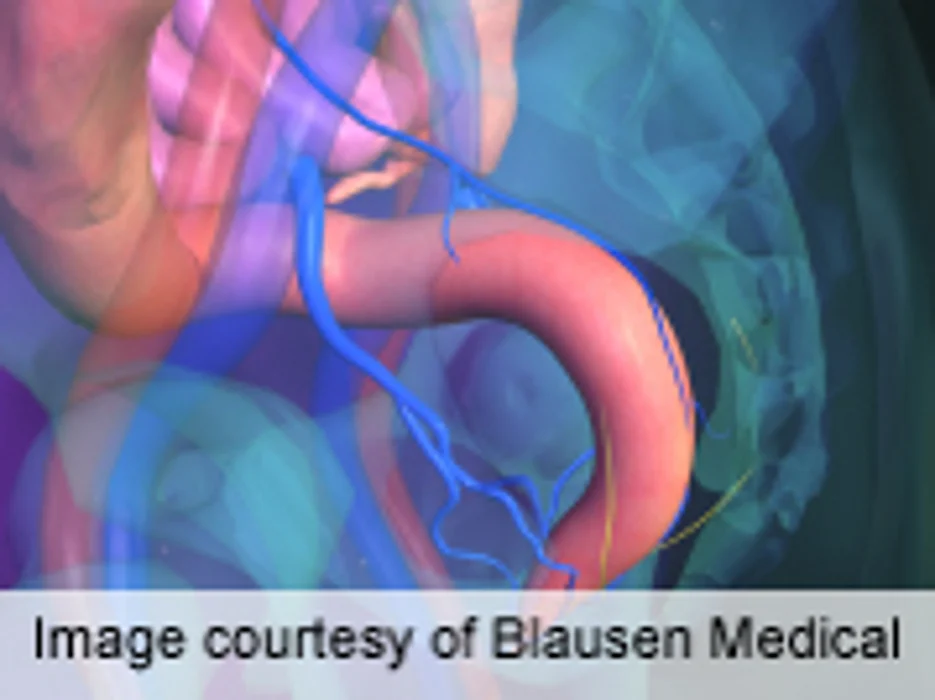 Fecal Incontinence Costs ~$4,000 Per Patient Annually