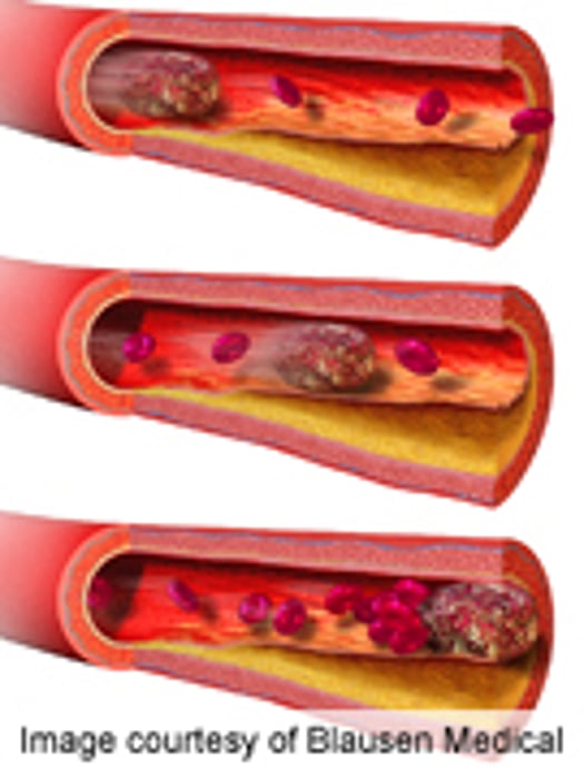 Many Suffer Leg, Lung Clots While Hospitalized: CDC