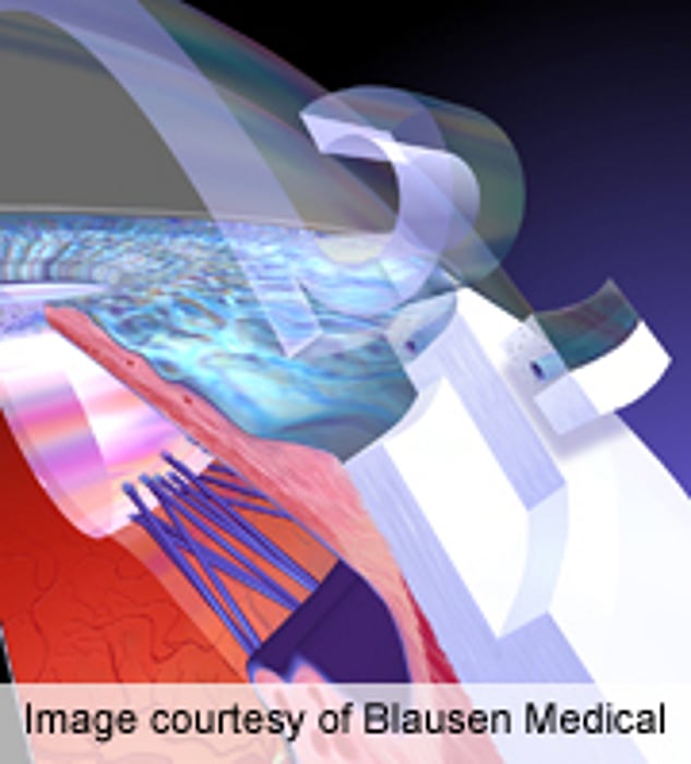 Study Participation Ups Adherence for Glaucoma Patients