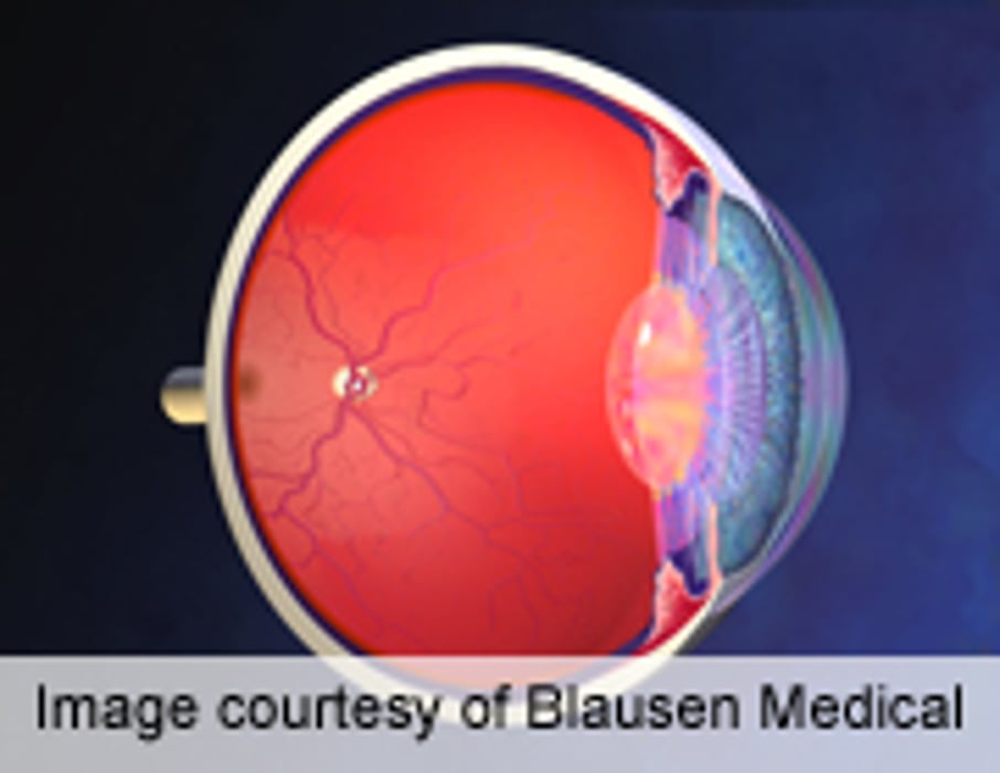 Simple, Noninvasive Eye Test May Identify Risk for Stroke