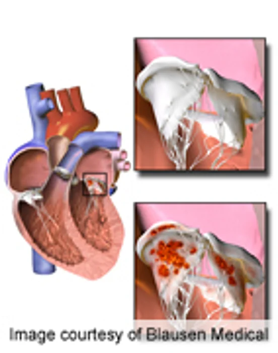 High Burden of Endocarditis in Older Adults