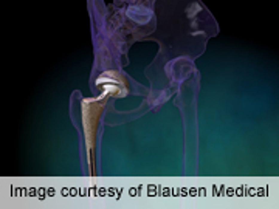 Increased Risk of Heart Attack After Hip, Knee Replacement