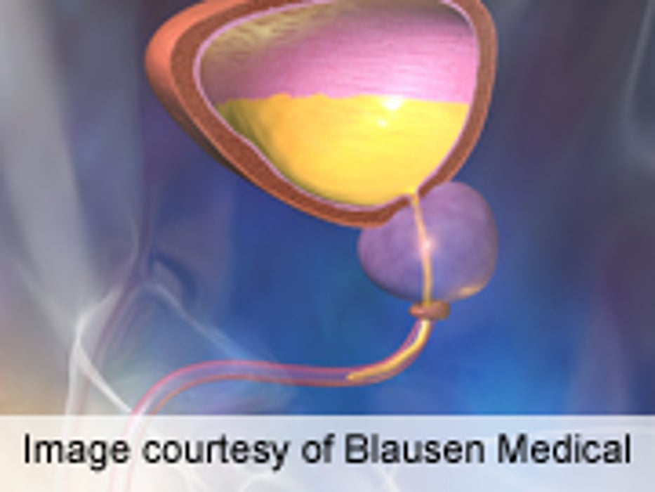 Detection Bias May Explain Raised Bladder CA Risk in T2DM
