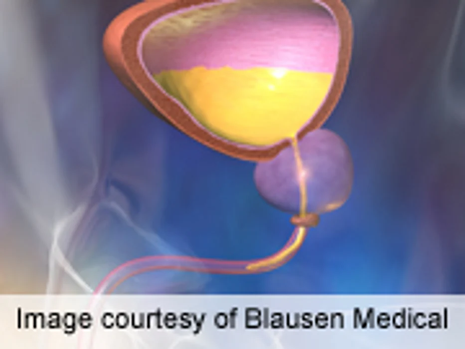 Prognosis After Cystectomy Not Affected by Smoking