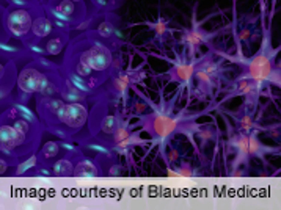 Scientists Use Stem Cells to Mimic Huntington's Disease