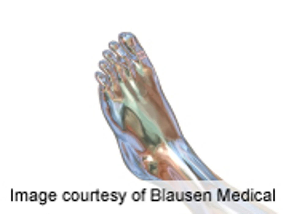 Ultrasound Model IDs Residual Joint Inflammation in RA