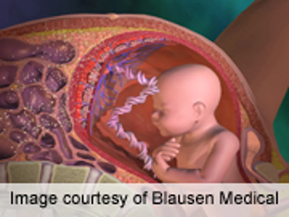 Metformin Usually Adequate for Control of Gestational Diabetes