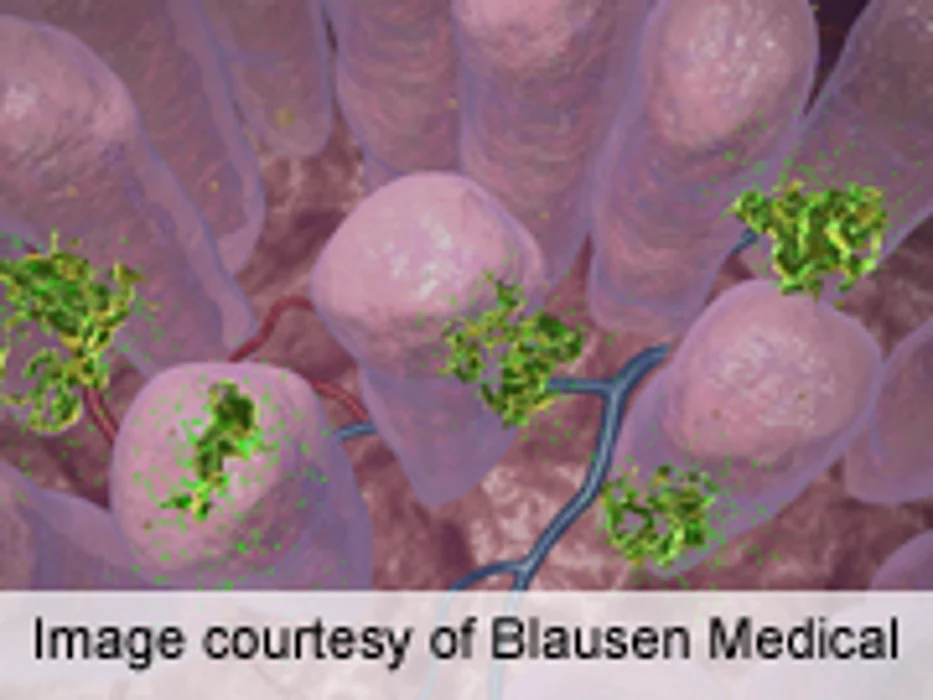 ASCO: Vitamin D Tied to Colon Cancer Progression, Survival