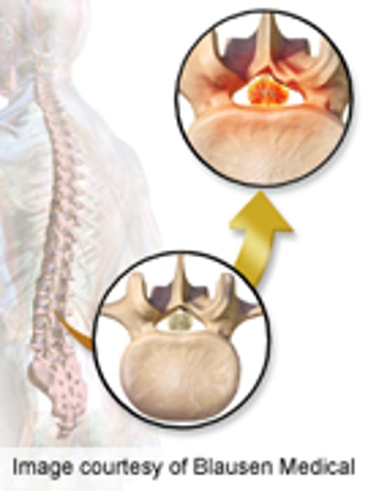 Tests ID'd for Use in Outcome Assessment of Spinal Stenosis