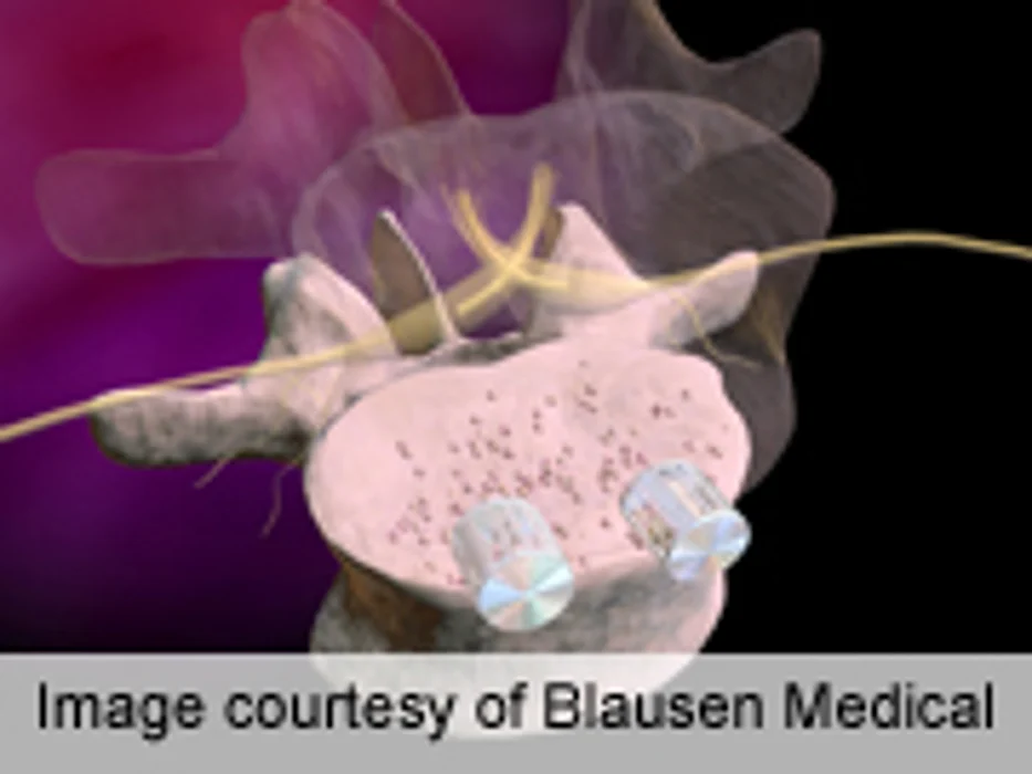 Insulin Dependence Ups Post-Op Complication Risk
