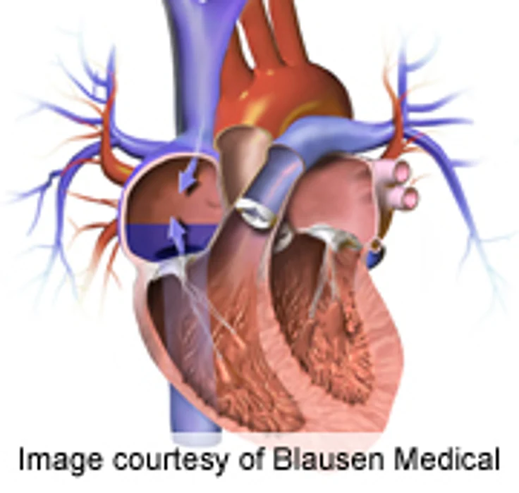 IVC Filters Confirmed Effective for Patients at Embolism Risk