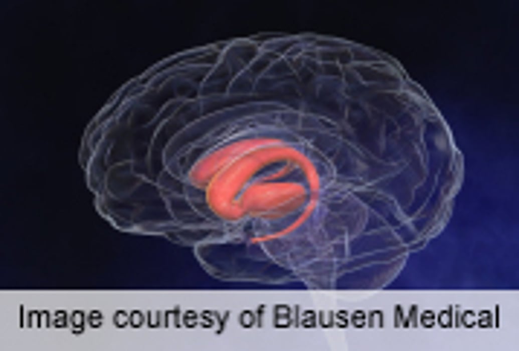 Deep Brain Stimulation May Help in Early Stages of Parkinson's