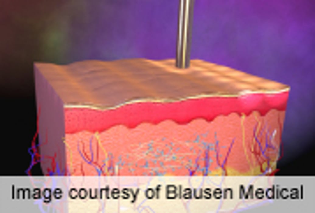 Low Fluence, Multiple Pass Laser Efficacious in Hair Removal - Consumer Health News | HealthDay Low Fluence, Multiple Pass Laser Efficacious in Hair Removal - Consumer Health News | HealthDay